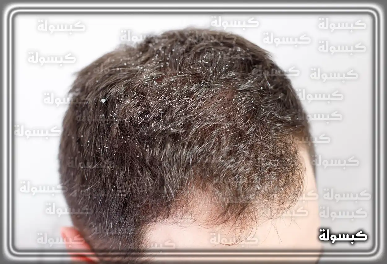 دلالة القشرة في حلم الرجل