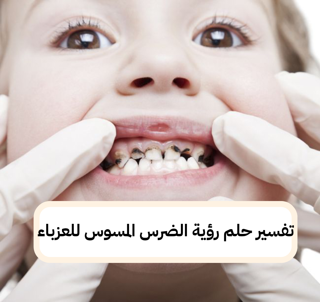 تفسير حلم رؤية الضرس المسوس للعزباء في المنام