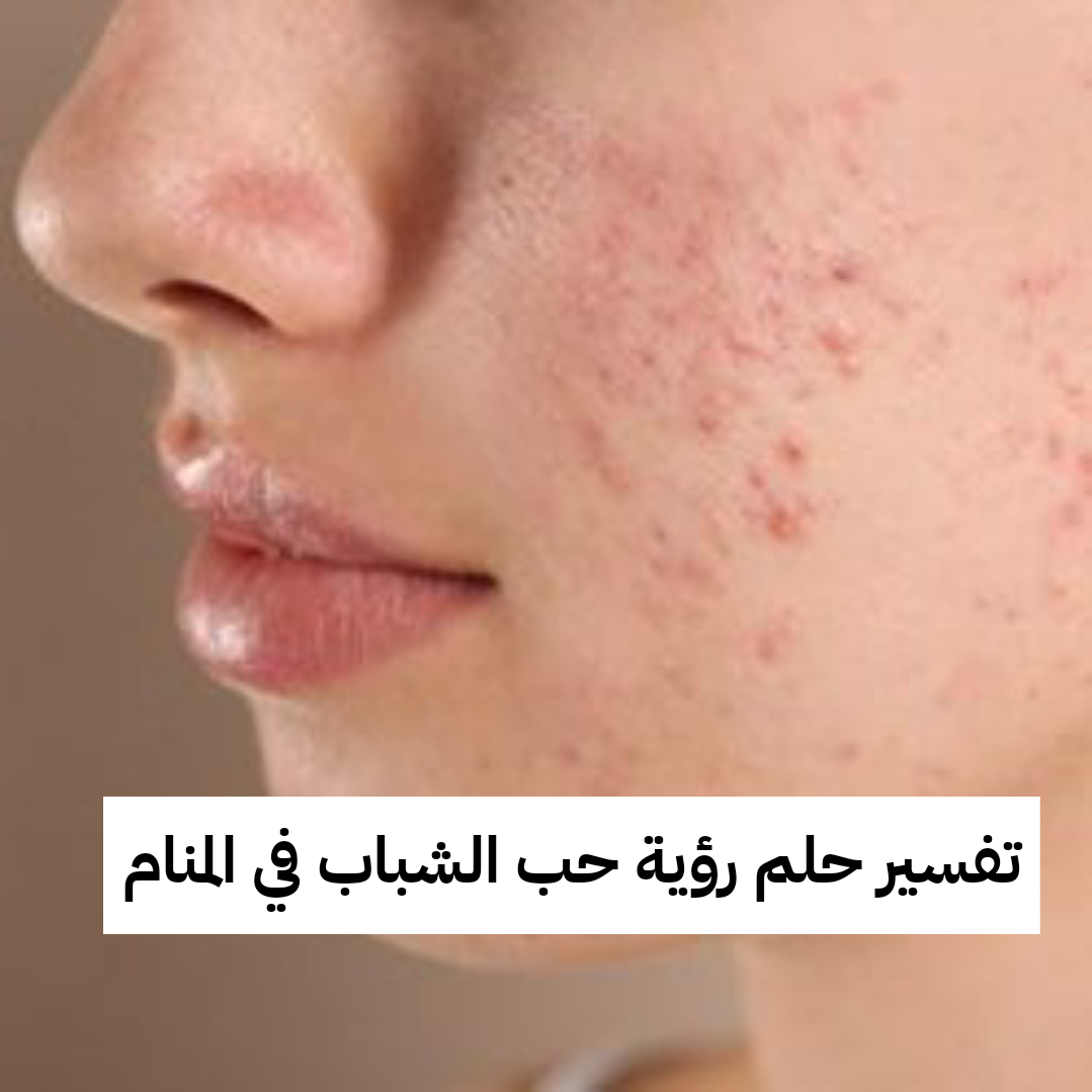 تفسير حلم رؤية حب الشباب في المنام