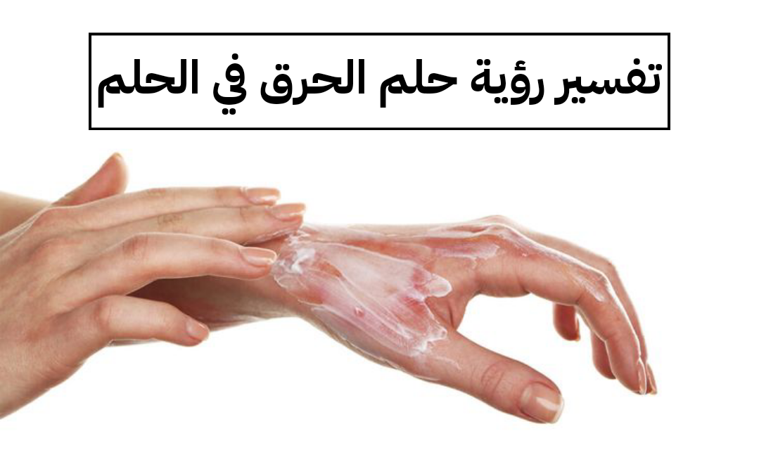 تفسير رؤية حلم الحرق في الحلم بالتفصيل