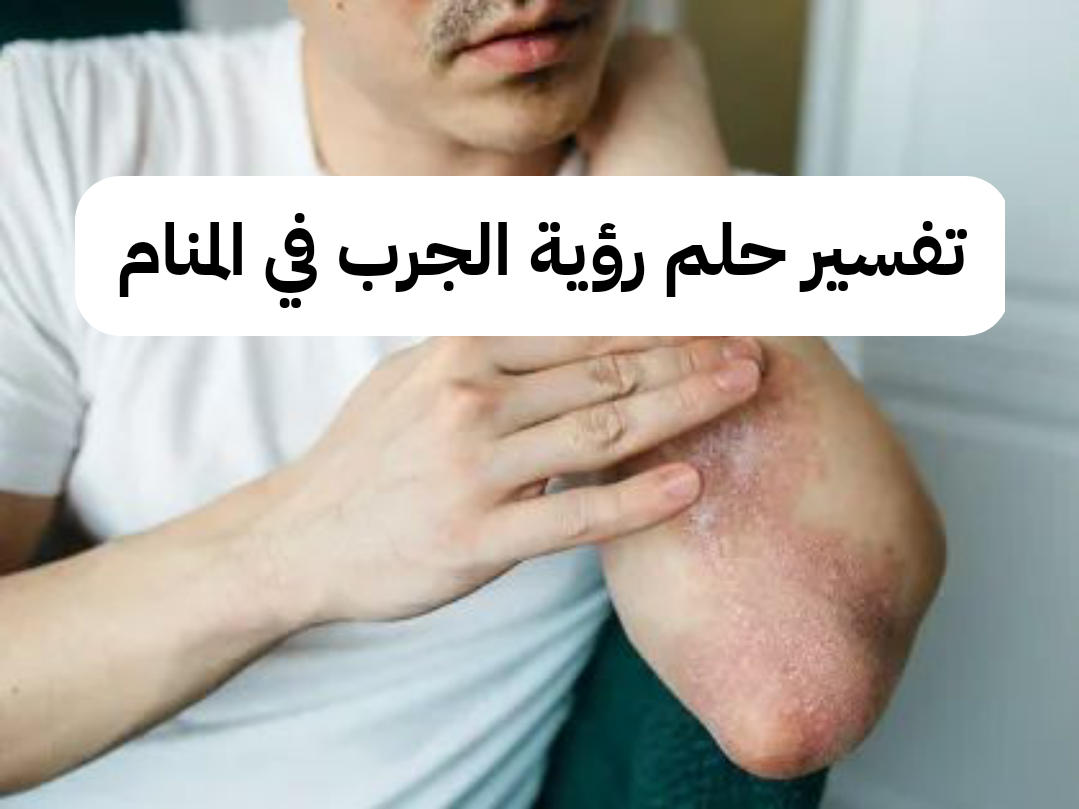 تفسير حلم رؤية الجرب في المنام