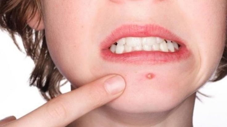 تفسير رؤية الدمامل في الحلم