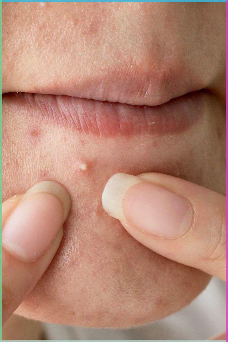 تفسير حلم الدمامل في المنام