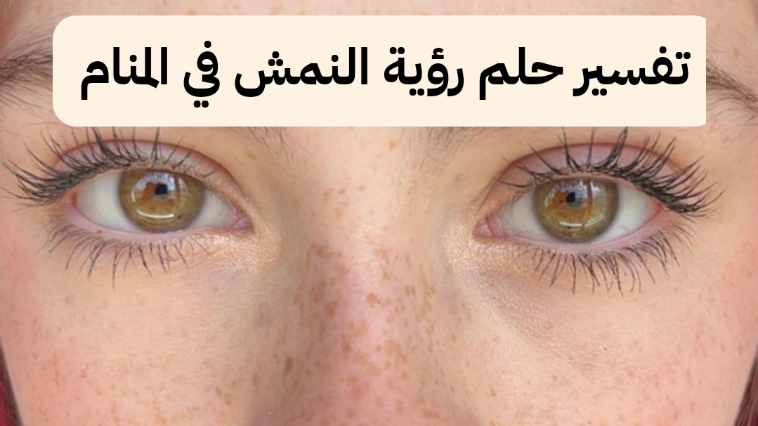 تفسير حلم رؤية النمش في المنام