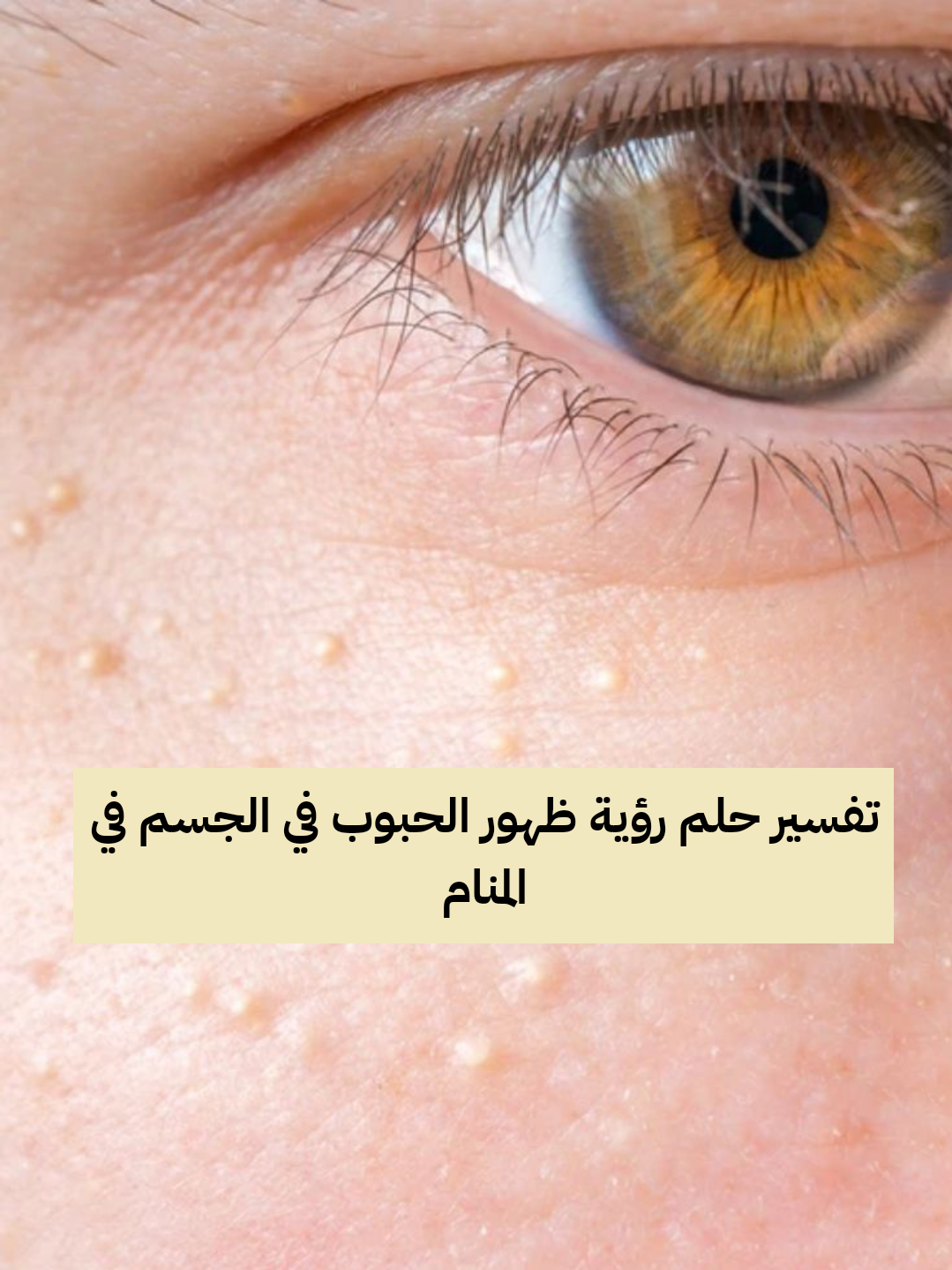 تفسير حلم رؤية ظهور الحبوب في الجسم في المنام