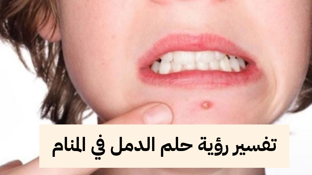 تفسير رؤية حلم الدمل في المنام .. رزق وإنتهاء الهموم