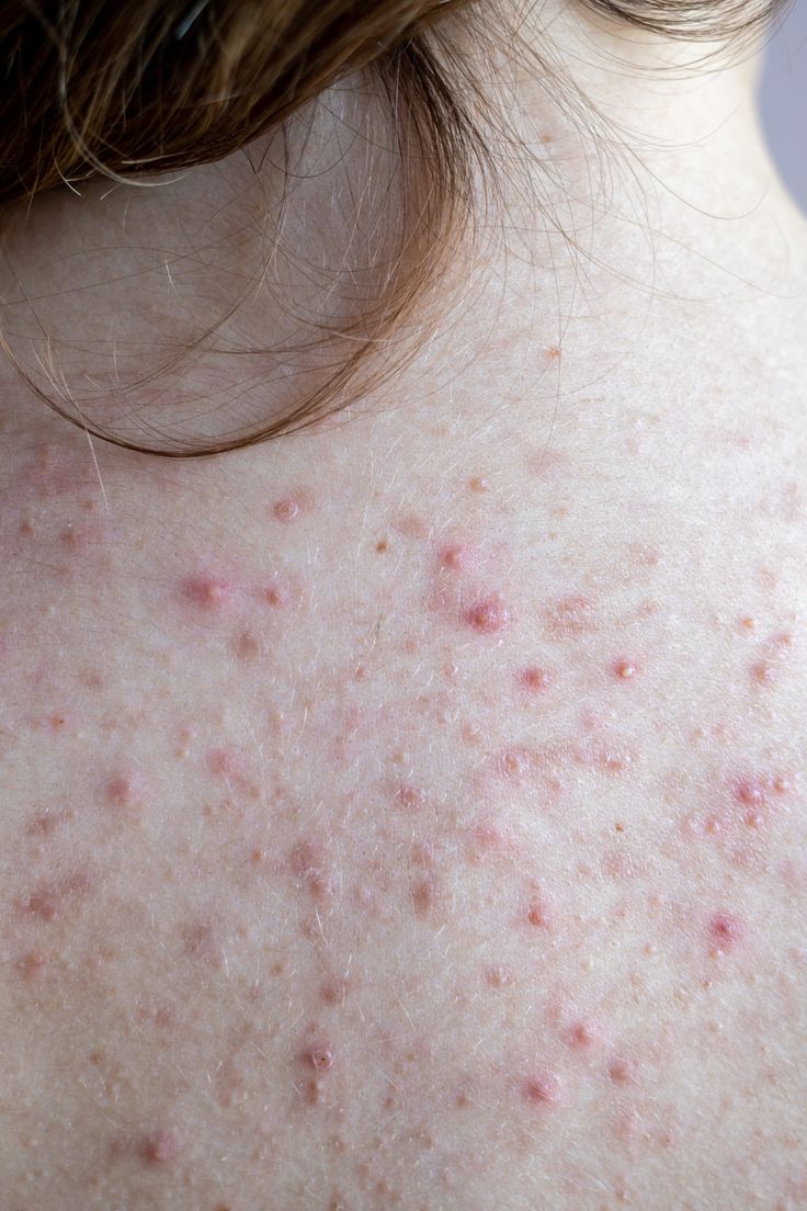 تفسير حلم الدمل أو الخراج في المنام