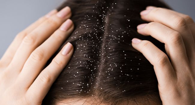 تفسير رؤية القمل في المنام