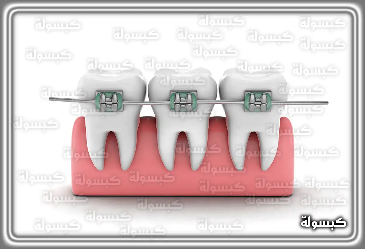 صورة توضيحية لتقويم الأسنان