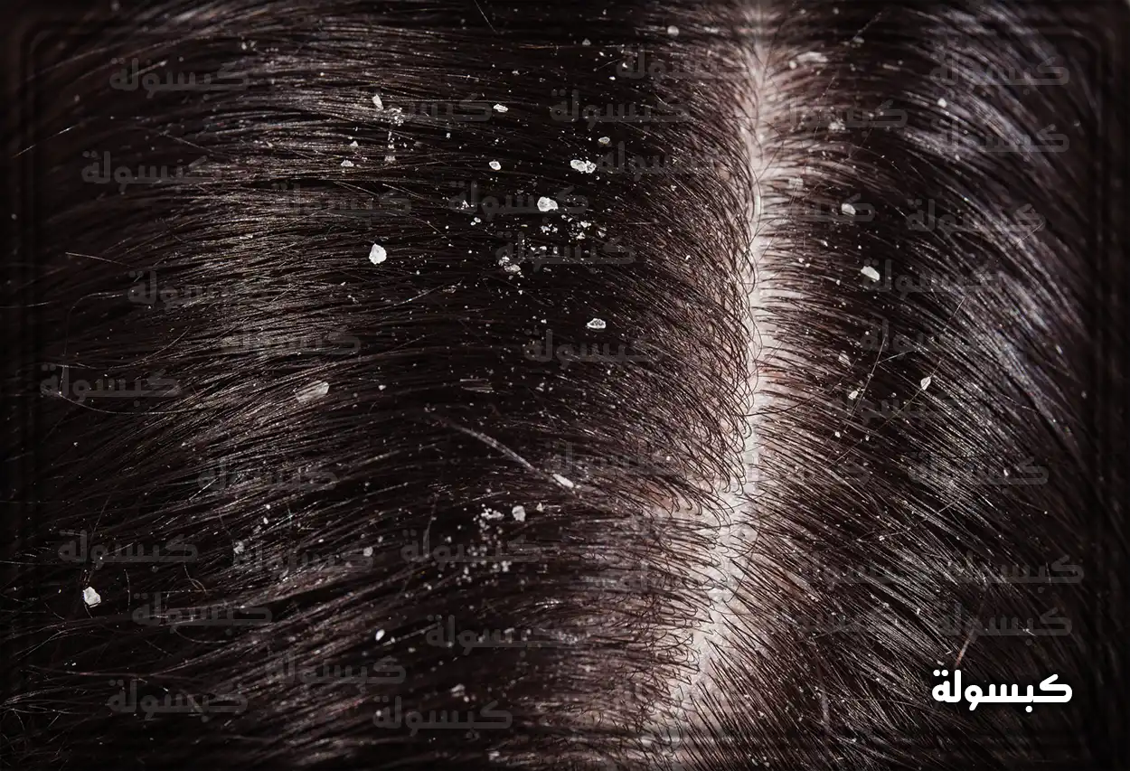 تفسير حلم قشرة الشعر للعزباء