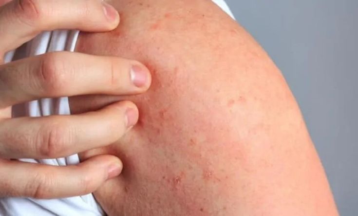 تفسير حلم الجرب في المنام