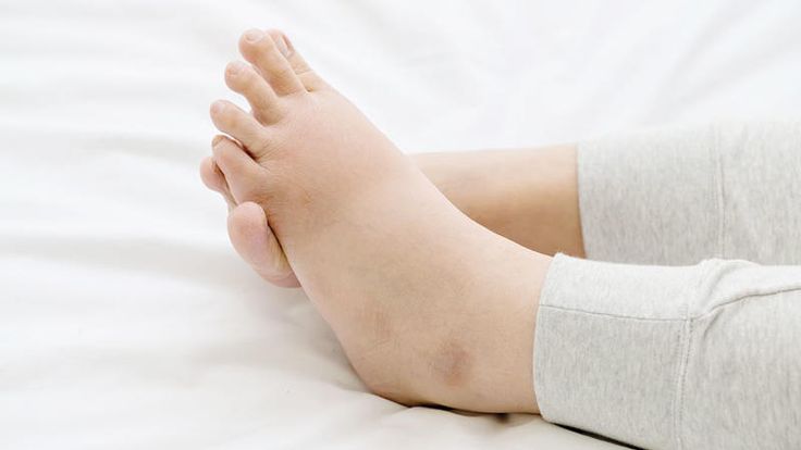 تفسير حلم التورم في المنام