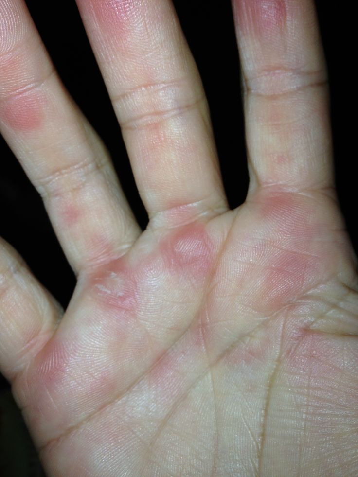 تفسير رؤية آثار الحروق في المنام